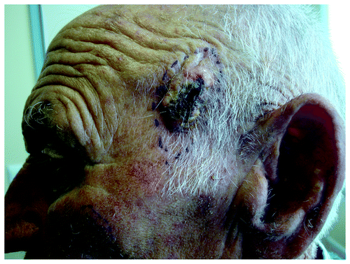 Figure 6. Histologically confirmed SCC on left temporal area of an elderly man, multiple actinic keratoses on left ear and lentigo maligna on his left cheek.