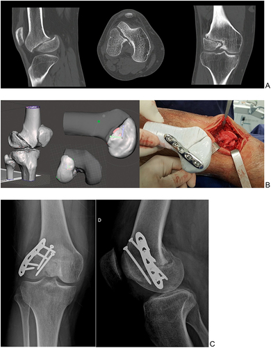Figure 3 CT images showing nonunion of the coronal femoral lateral condyle fracture - Hoffa’s fracture (A); virtual surgical planning (VSP) performed in CAD software (Meshmixer®) and the 3D printed model used in surgical procedure to reproduce the VSP (B). Outcome of surgical treatment (C).