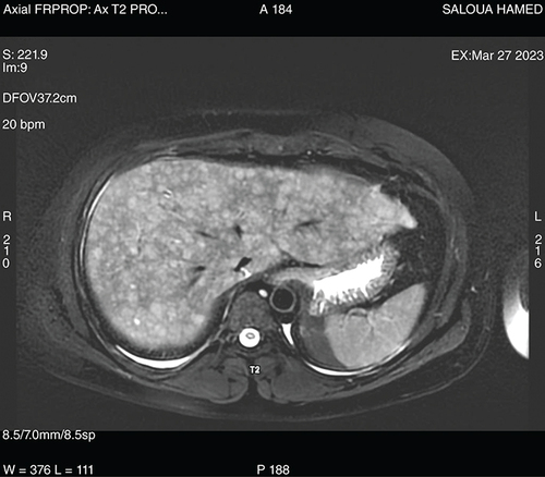 Figure 2. Liver MRI revealing a multiple nodular infiltration of the liver, with hyperintense signals on T2-weighted imaging.