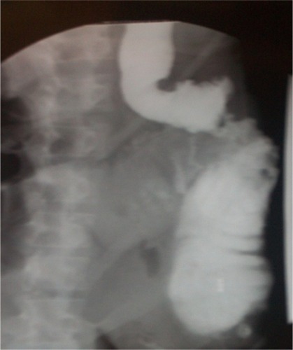 Figure 2 Single contrast enema identifying a stricturing lesion in the left colon.