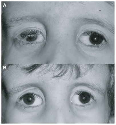 Figure 2 (A) Preoperative and postoperative features in the right and in the left eye, respectively, at 3 months. (B) Postoperative features in the right and in the left eye respectively at 9 and 12 months.