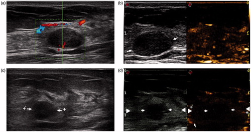 Figure 3. Conventional US and CEUS images in a 38-year-old woman before and 3 days after MWA. (a) Conventional US shows a tumour with a clear margin before MWA. (b) CEUS shows heterogeneous enhancement before MWA. (c) The tumour (arrow) shrank after ablation, but it is still clear in US. (d) The tumour (arrow) locates in the centre of the ablation zone (arrow-head) in CEUS. This case is defined as concentric type.