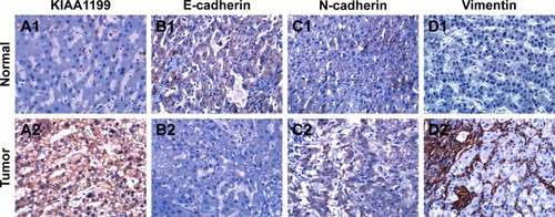 Figure 1 Immunohistochemical staining for KIAA1199, E-cadherin, N-cadherin and vimentin. Magnification 400×.