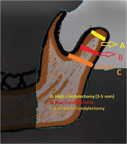 Figure 1. Types of condylectomy procedures based on the level of resection