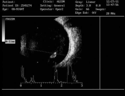 FIGURE 2  B-scan ultrasonography with vector A scan showing a cystic echo with high reflective clump at the edge noted at the inferior vitreous cavity.