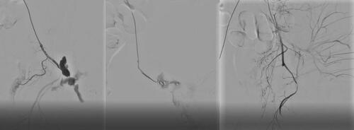 Figure 5 Superselective catheterization of the gluteal artery and occlusion of this latter by detachable coils.