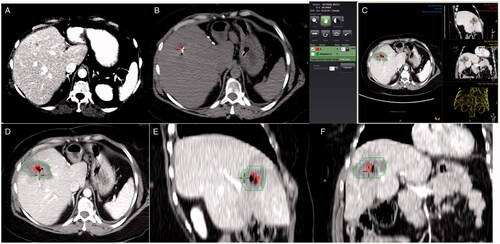 Figure 1. Measurement of ablation margins in 3 D in a patient with colorectal liver metastasis in segment 8. Pre-ablation contrast-enhanced CT scan 2 days before the procedure (A). Segmentation of the tumor (red) in the pre-ablation CT scan of the day of the procedure (B). General view of the software interface for ablation margin assessment (C). Detail of the tumor (red) and the ablation zone (green) in axial, sagittal, and coronal plane (D–F), showing adequate ablation margins in all three planes.