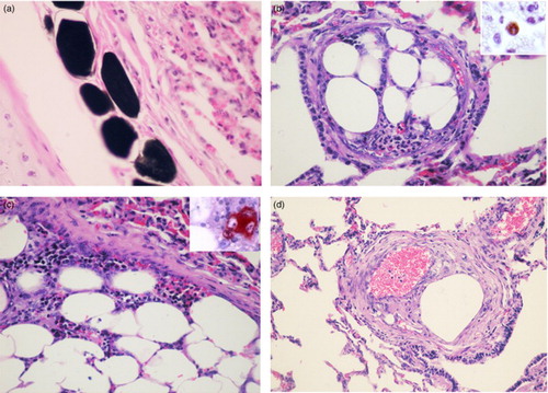 Figure 1. Lung; 8-month-old Holstein calf. (a) Dark-staining in small fat emboli within peribronchial vessels. OsO4 postfixation. Haematoxylin and eosin (HE). 400X. (b) Bone marrow embolus within a pulmonary artery. HE. 200X. Inset: Immunoreaction to anti-MAC387 in the cytoplasm of a macrophage within a pulmonary embolus. ABC method, 3-amino-9-ethylcarbazole (AEC) chromogen. 400X. (c) Detail of the fat and haematopoietic cells components of the emboli. HE. 400X Inset: Anti-FVIII-related antigen in a megakaryocyte. ABC method, chromogen. 400X. (d) Pulmonary artery with intimal fibromuscular hyperplasia associated with the presence of an embolus. HE. 100X