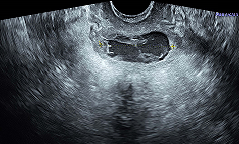 Figure 5 Grayscale ultrasound image showing the length of a mass (2020.06.15).