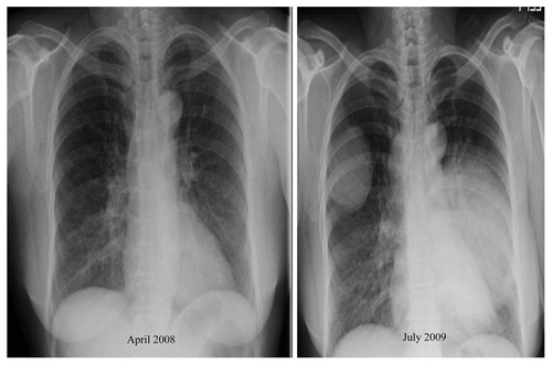 Figure 1. Chest radiograph taken on admission compared with the one taken in 2008.The aggressive nature of the tumor is clearly evident by the rapid growth. Six month follow-up X Ray (January 2010) shows increase in the size of the tumor after three cycles of cisplatin and etoposide.