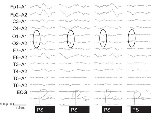 Figure 2 Electroencephalographic findings on hospital day 57.