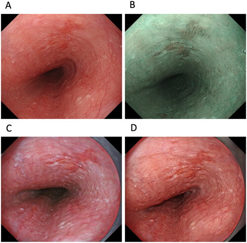 Figure 2. A case of oesophageal squamous cell carcinoma (ESCC). ESCC observed by (A) white-light imaging (WLI), (B) narrow-band imaging, (C) texture and colour enhancement imaging (TXI) mode 1 and (D) TXI mode 2. Compared to WLI, TXI modes 1 and 2 emphasize the redness of the ESCC, making the boundary with the surrounding non-carcinoma normal oesophageal mucosa clear.