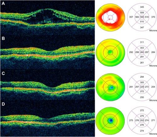 Figure 51 Sequential Stratus OCT images from a 64-year-old man with a 4-month history of loss of vision, to 20/160, in his right eye, in whom refractory pseudophakic cystoid macular edema had developed.