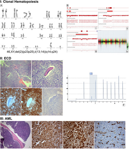 Figure 1 I: Clonal hematopoiesis. (Α) G-banded chromosome preparation. The arrows indicate the rearranged chromosomes. (Β) Detailed view of array analysis for chromosomes 2, 13, and 14, respectively (A–C). Regions with a DNA copy number loss are indicated in red, and intervals with gains are highlighted in blue. Whole-genome profiling by microarray identified multiple genomic imbalances (D). Microarray probes are arranged according to their physical map locations on each chromosome from the distal p-arm (on the left) to the distal q-arm (on the right). Chromosomes are plotted in a horizontal fashion and marked with different colors. An average logarithmic ratio (log2) is displayed for all oligonucleotide probes. Probes with a log2 ratio clustered around zero indicate DNA segments with normal copy numbers. A positive log2 ratio (above zero) indicates a gain (extra copy) of the chromosomal region, while intervals with a negative log2 ratio (below zero) represent loss of DNA copy number. II (A–E) Histopathologic findings of Erdheim-Chester disease. Bone tissue section showing intense fibrohistiocytic infiltrate (A), with prominent proliferation of foamy histiocytes (B). Immunohistochemistry revealed immunopositivity of the infiltrate for CD68 (C) and CD163 (D), but not for S100 (E). (A and B) Hematoxylin and eosin stain, 100x and 200x magnification, respectively; (C–E) immunohistochemistry, 200x magnification. (F) Pyrosequencing assay highlighting the presence of the BRAFV600E mutation in tumor cells (nucleotide substitution 1799T>A, frequency 15% units). III (A–D) Histopathologic findings of acute myeloid leukemia with mutated NPM1. Bone marrow tissue section showing abnormally increased (>98%) cellularity (A). Immunohistochemistry revealed immunopositivity of the blastic infiltrate for myeloperoxidase (B) and NPM1 (C, nuclear and cytoplasmic staining) but not for CD34 (D). ((A): hematoxylin and eosin stain, 100x magnification; (B–D) immunohistochemistry, 400x magnification).