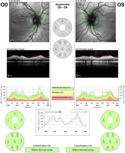 Figure 3 Spectral-domain optical coherence tomography (SD-OCT Spectralis, Heidelberg) analysis of patient 2. SD-OCT imaging documented peripapillary retinal nerve fiber layer (pRNFL) thickening in superior and inferior sectors.