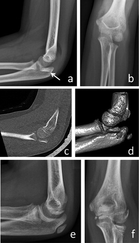 Figure 2. A 7-year-old girl had a type-B lesion after falling on a level surface (panels a and b). Note the hardly visible radial head on conventional radiographs (arrow). A CT scan (panels c and d) revealed the location of the radial head. Open reduction and elastic stable intramedullary nailing (ESIN) was necessary. 19 months later, there were signs of shortening and angulation but no evidence of avascular necrosis (panels e and f). Clinically, the patient was free of symptoms, with full range of motion and a Linscheid-Wheeler score of I.