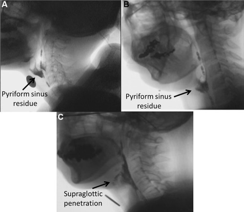 Figure 3 VF images of typical cases in each group; pyriform sinus residue in a patient with DMD and DM1 (A and B, respectively) and supraglottic penetration in a patient with ALS (C).
