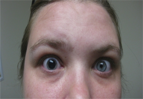 Figure 1 Intermittent right pupil dilation.