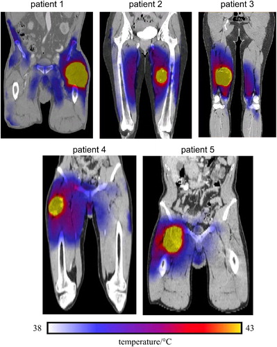 Figure 6. Coronal cross-sections thermal maps, overlaid on CT images, of the five STS patients generated from the HTP_I. The maps show relative inhomogeneous temperature distributions within the HT-GTV. Note that some hot spots are developed either within the muscle tissue or close to the bone.