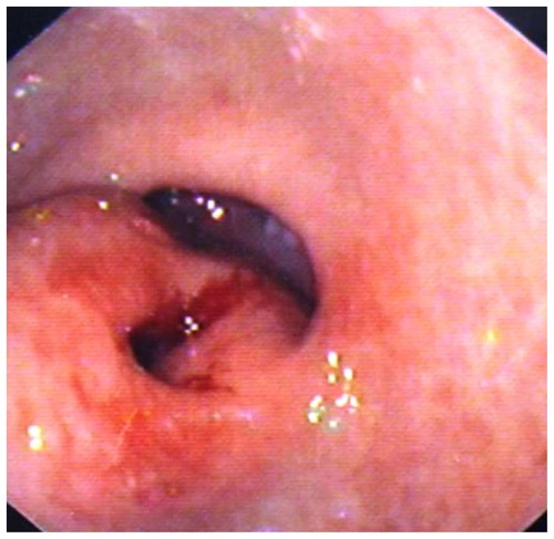 Figure 2 Esophagogastroduodenoscopy of the tumor in the gastric antrum.