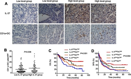 Figure 1 Relationship between IL-37 expression and CD1a+ DC frequency in the tumor microenvironment. (A) Representative immunohistochemical images of IL-37 and CD1a in the same primary hepatocellular carcinoma (HCC) tumors (original magnification: ×200). (B) IL-37 expression positively correlated with the density of CD1a+ DCs in HCC tumors. (C and D) The overall survival (OS) rate and disease-free survival (DFS) rate of Patients.