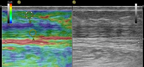 Figure 5 Sonoelastogram (left side of the images) of the musculotendinous junction of the AT Achilles tendon and corresponding B-mode ultrasound images (right side of the images) of the same area.