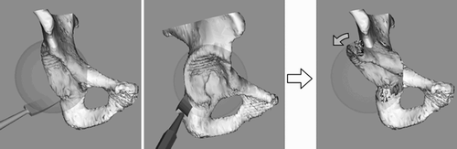 Figure 1. Rotational acetabular osteotomy (spherical type) with a conventional curved chisel.