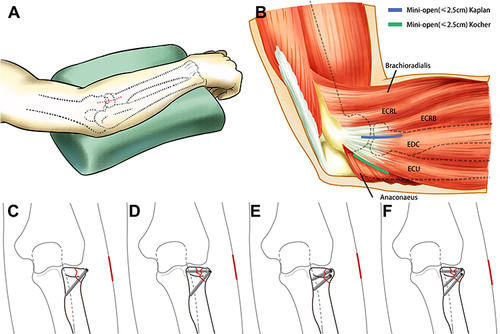 Figure 3 Different screw fixation methods were used for fixation of different types of fractures. (A) Schematic diagram of intraoperative posture and mini-open incision. (B) Two main surgical approaches in our study: mini-open Kocher approach and mini-open Kaplan approach. (C) Single screw only for Mason type II fractures and the fracture block is small. (D) Two screws are required when the bone is large. (E) When a Mason type III fracture has two small fracture blocks, the first screw is used to fix two small blocks into one piece, and the other is used to fix the block to the radial head. (F) When a Mason type III fracture has two fracture blocks, one of which is larger, the first screw is used to fix the two blocks into one piece, and the others are used to fix the block to the radial head.