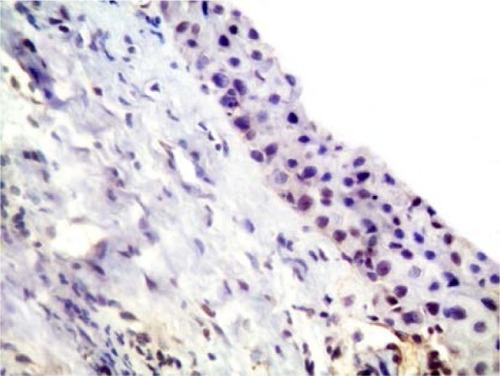 Figure 9 A photomicrograph of injected pterygium-immunostained section showing a small number of subepithelial CD31-positive vessels.