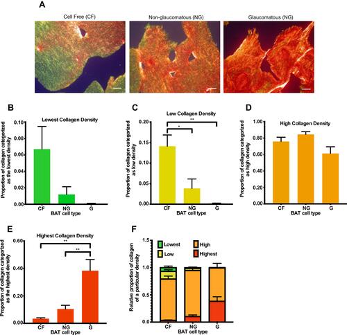 Figure 4 Comparing collagen remodeling in BATs containing no cells (CF) or imbued with HTCFs extracted from patients medically treated for glaucoma (glaucomatous; G) and patients not treated for glaucoma (non-glaucomatous; NG). Images were taken using a 20x objective of an Olympus BX-51 microscope (A) after the cells were imbued 168 hours in the BATs. Pixel density for each color, which corresponded to a particular collagen organization, was quantified using ImageJ. ImageJ analysis revealed that the proportion of green stain (B) in the BATs was not significant between any of the treatments. The proportion of yellow stain (C) in BATs containing HTCFs from glaucomatous and non-glaucomatous patients was significantly lower than the cell free control. The proportion of orange stain (D) in the BATs was not significant between any of the treatments. BATs imbued with HTCFs from glaucomatous patients had a significantly greater proportion of red staining (E) with respect to the non-glaucomatous treatment group. The values were expressed as a mean ±SE from four independent experiments (*P<0.05 and **P<0.01). A schematic representing the proportion of collagen undergoing very low, low, high and very high degrees of remodeling for each experimental condition (F). Scale bar is approximately 20 μm.