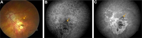 Figure 1 Fundus photograph (A) at presentation demonstrates stable findings following macular translocation for age-related macular degeneration, with geographic atrophy along the inferior arcades and no visible heme, fluid, or exudates. Early (B) and mid-phase (C) fluorescein angiograms at presentation demonstrate a small leaking juxtafoveal choroidal neovascularization lesion (orange arrow). A window defect corresponding to the inferior atrophy is also noted. No ophthalmoscopic evidence for active choroidal neovascularization is visible (orange arrow, A).