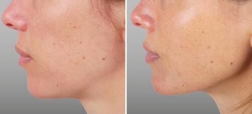 Figure 17 Before and after photos of a patient treated for jawline rejuvenation. Courtesy Jani van Loghem, MD. Patient was also treated in other facial indications.