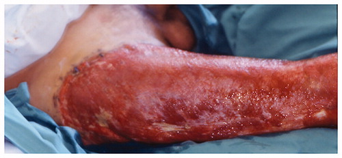 Figure 2. Injury three weeks after admission showing circumferential degloving of the right thigh with deep soft tissue injury at the popliteal fossa.