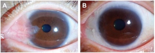 Figure 5 Preoperative and postoperative appearances in the representative case. Notes: (A) Before the surgery. (B) At 1.9 years after the surgery.