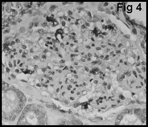 Figure 4 CD68 positive macrophages were noted in the glomerulus.