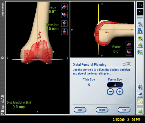 Figure 4. Sample screenshot from the BrainLAB CAS system showing a virtual implantation of the femoral component to determine the desired component positioning and required cuts; the dots represent digitized points on the bone surface. (Image courtesy of BrainLAB.)