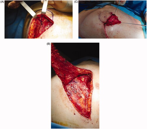 Figure 2. Flap raising. After perforator identification, incision of the lower margin and flap raising (A). (B) De-epithelialization and transposition of the proximal portion of the flap. (C) The wound 1 week post-op.