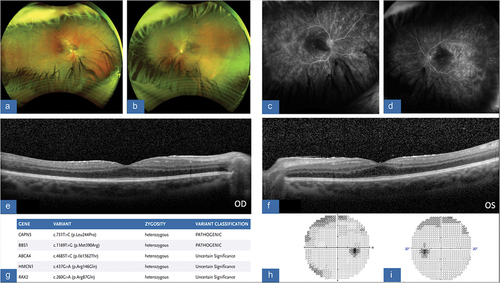 Figure 6. (A/B) color fundus photograph, OD/OS, with evidence of RPE disruption along with a tractional membrane, greater in temporal OS>OD. (C/D) FA, OD/OS, revealing of areas of non-perfusion along nasal and temporal peripheries of the retina. There is global inner retinal and outer retinal non-perfusion with leakage. (E/F) OCT macula, OD/OS, showing diffuse retinal thickening and enlarged outer plexiform and outer nuclear layer. Vitreous debris is noted OS as well as small intra-retinal cysts. (G) SPARK genetic testing showing gene mutations and variants, consistent with pathogenic CAPN5 mutation as well as BBS1 and ABCA4. (H/I) HVF 30–2, OD/OS, demonstrates defects in visual field mostly involving the superior aspect in an arcuate pattern.