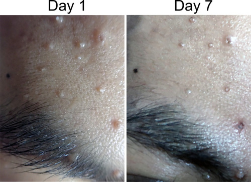 Figure 3 Clinical manifestation of molluscum contagiosum on the face before and after 20% KOH treatment. Some of the MC lesions were thinning on day 7.