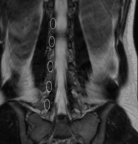 Figure 4 Coronal MRI slice of an adult normal lumbar spine. The left pedicles of L1-L5 have been circled here and demonstrate a natural oblique tapering. Notice the intertransverse distance between the pedicles becomes greater with the lower lumbar spine vertebrae.