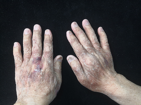 Figure 2 Purpura, petechiae and ecchymoses of the skin and fingernails dystrophy.