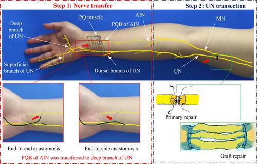 Figure 1 The injured ulnar nerve is repaired at the injured site (primary or graft repair), and then the branch of the pronator quadratus muscle is transposed to the deep branch of the ulnar nerve at the wrist level (via end-to-end or end-to-side anastomosis). Red arrows indicate where nerve repair is being performed.Abbreviations: MN, median nerve; UN, ulnar nerve; AIN, anterior interosseous nerve; PQ, pronator quadratus; PQB, pronator quadratus branch.