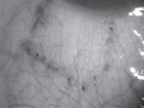Figure 1 Marking of donor conjunctival site.