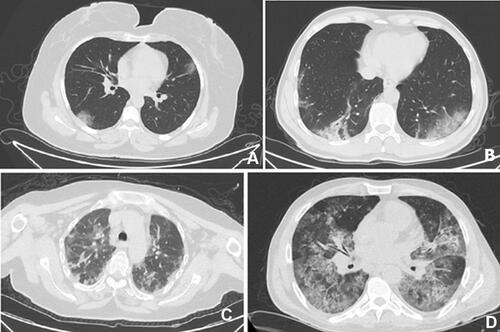 Figure 2 Typical thoracic CT findings: (A) Peripheral ground-glass opacifications; (B) Bilateral ground-glass opacifications; (C) Multifocal involvement; (D) Diffuse involvement.