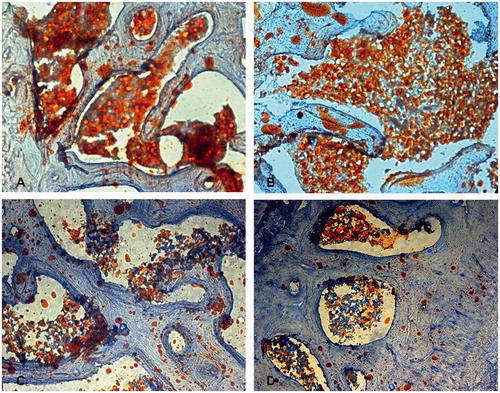 Figure 3. Hypertrophy and proliferation of adipocyte, increased fatty tissue in subchondral area of the femoral head noticed in animals in group M (A) treated with steroid only and group Con (B) treated with both steroid and the vector carrying irrelative sequence, while less adipocytes were found in group S (C) treated with both steroid and adenovirus shuttle vectors carrying siRNA targeting the PPARγ gene and group N (D) with no treatment (Stain, Sudan III; original magnification, ×100).