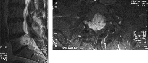 Figure 1. Sagittal (A) and axial (B) MRI after intravenous application of gadolinium. The L5 tumor protruded into the epidural space where it compressed the right L5 nerve root.