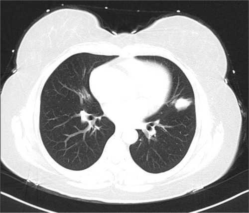Figure 1 Computed tomography scan showed an irregular abnormal soft tissue mass located in the left upper lobe.