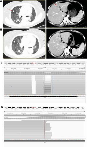 Figure 4 CT scans of the thorax prior to and following treatment with chemotherapy, everolimus and AZD9291 and NGS results of plasma ctDNA.