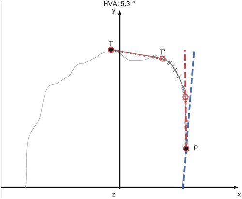 Figure 2. An example of the longest line segment between P, T (dotted line) connecting the first and the second toes. Since its angle (84.8°) to the baseline is larger than the angular criterion of 60°, the longest line segment between P, T′ is chosen to represent the line parallel to the first proximal phalanx. The blue dashed line is the baseline and the HVA (between the two dashed lines) is 5.3°.