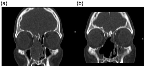 Figure 1. Contrast-enhanced coronal CT preoperative image (A) showing an expansive homogeneous mass located in the right nasal fossa with ethmoid sinus and septal involvement. No bone erosion is observed. (B) Postoperative CT scan.